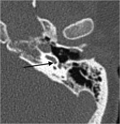 Implications of intracochlear decomposition gas formation in non-putrefied cadavers
